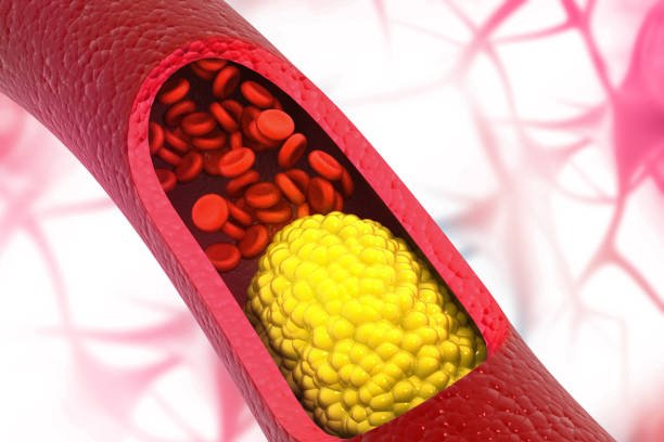 ischemic cardiomyopathy